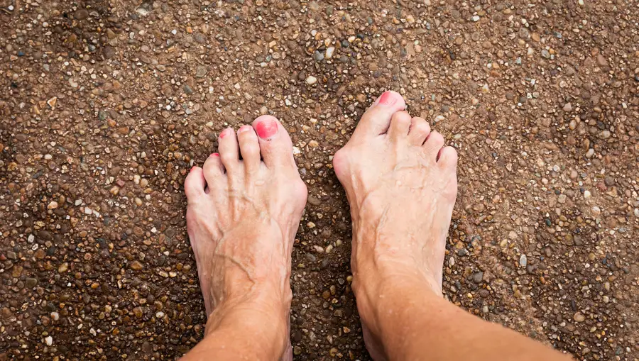 Minimally invasive bunion surgery Sunny Isles