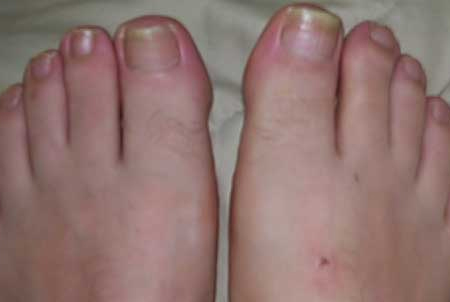 mild toe fungus treatment