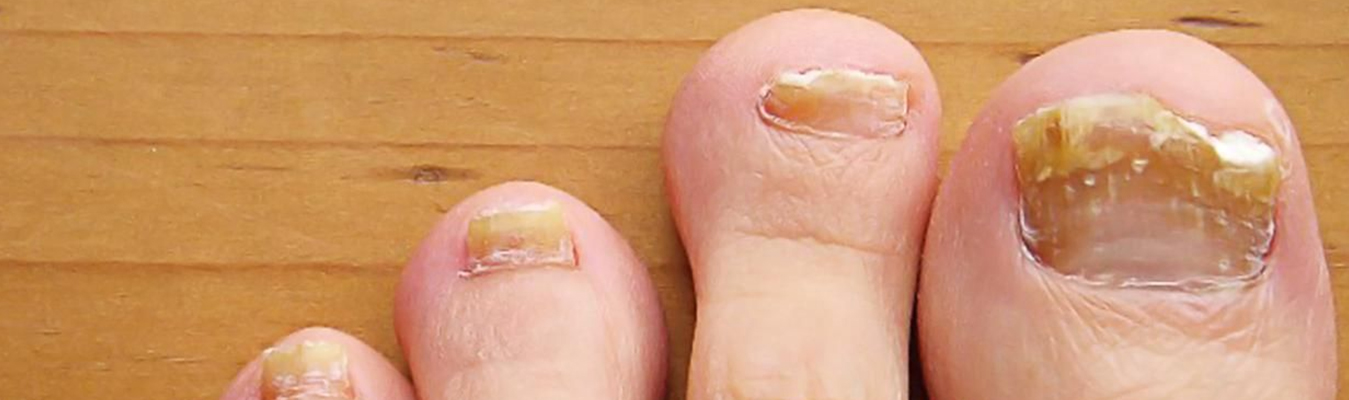 8 Home Remedies For Toenail Fungus To Try – Forbes Health