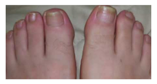 Care Management Options For Toenail Fungus | My FootDr