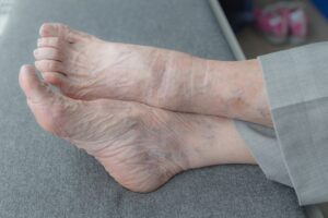 Athlete's Foot Treatment