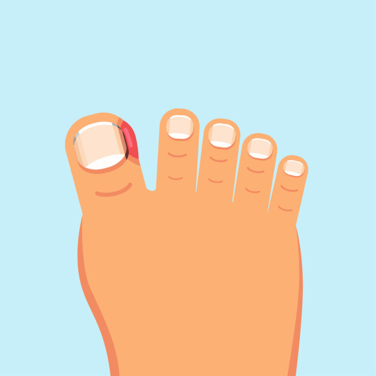 ingrown toenail treatment