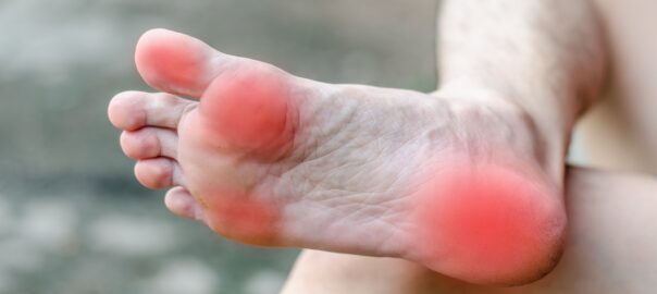 heel pain