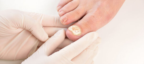 toenail fungus laser