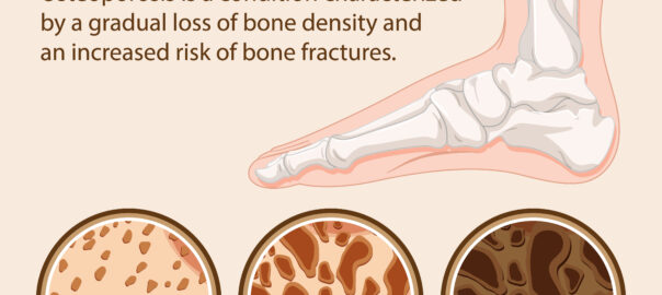 Osteoporosis in feet