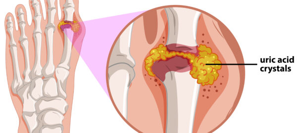 inflammatory arthritis