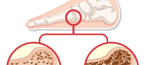 Foot Osteoporosis