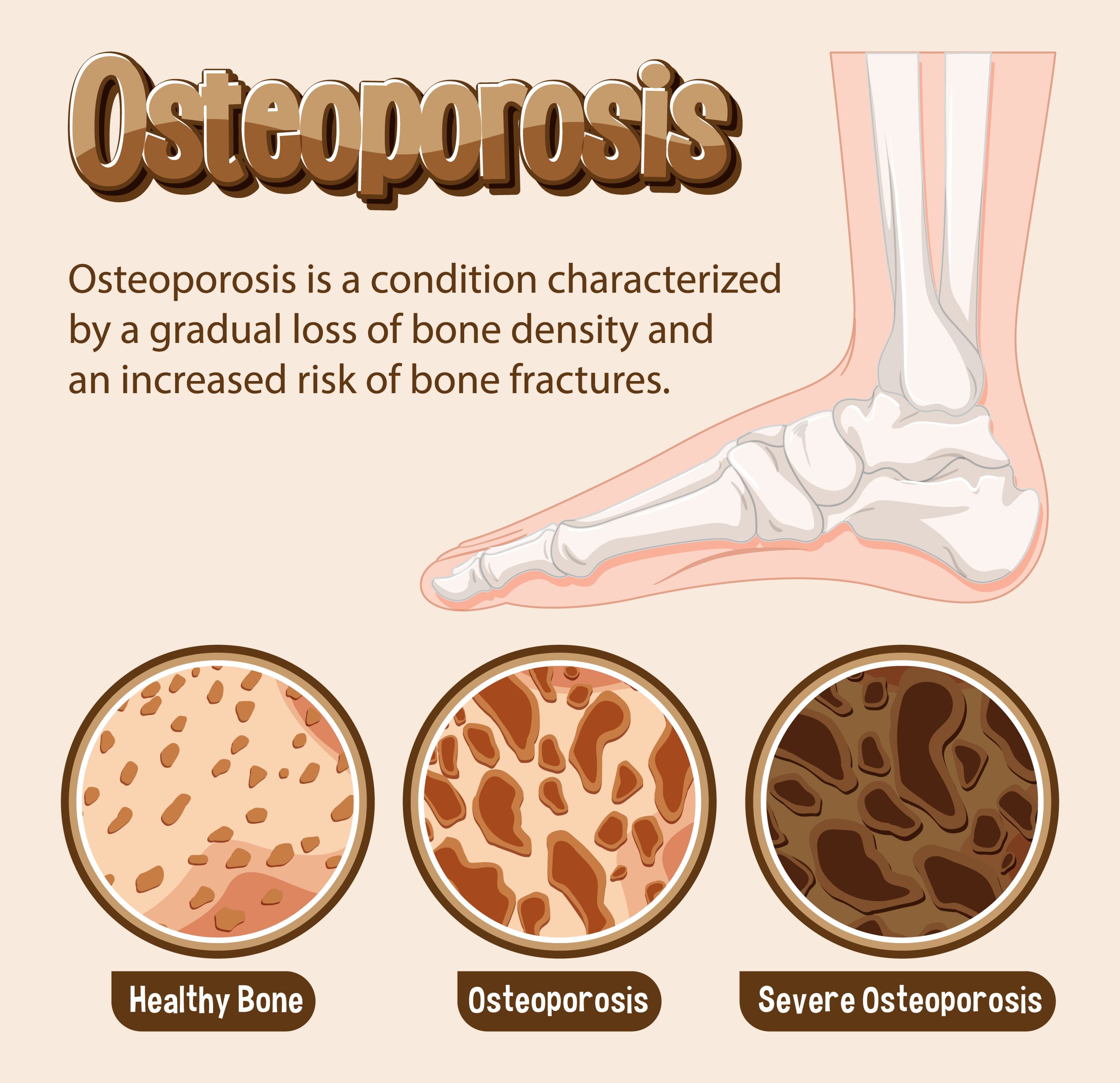Osteoporosis scaled scaled