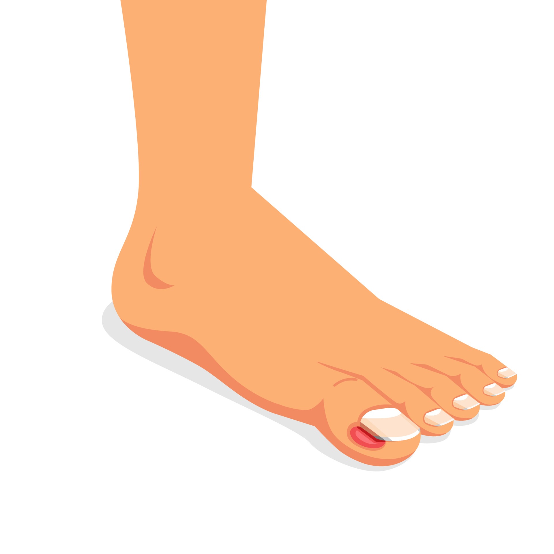 vecteezy ingrown nail onychocryptosis nail disease flat vector 17444130
