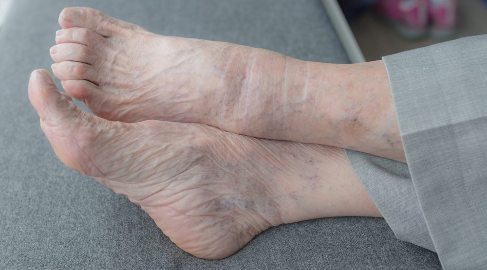 Athelets Foot scaled scaled