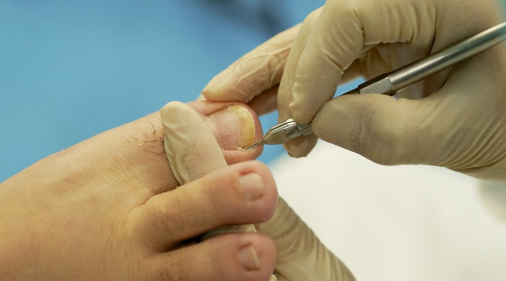 Nail fungus removal scaled scaled