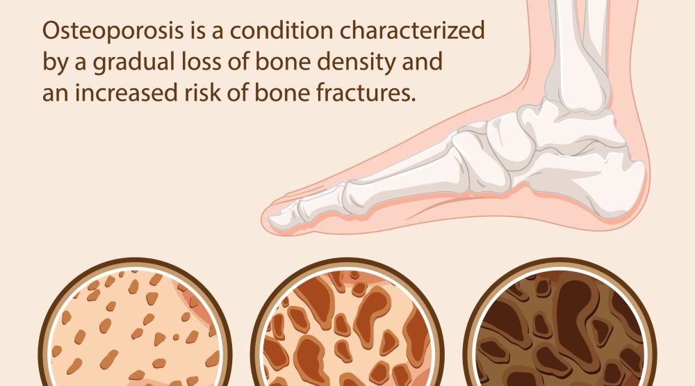 Osteoporosis scaled scaled