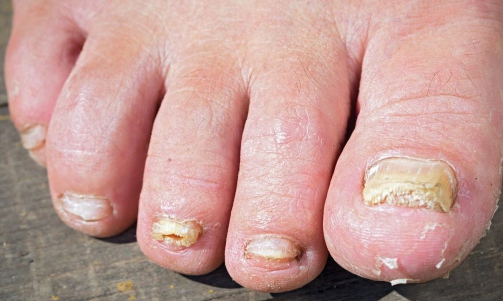 Toenail Fungus